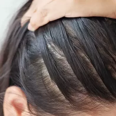 Scalp micropigmentation detail