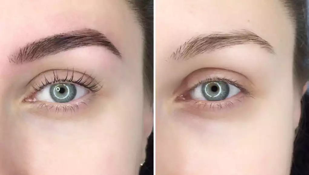 brow tattoo removal