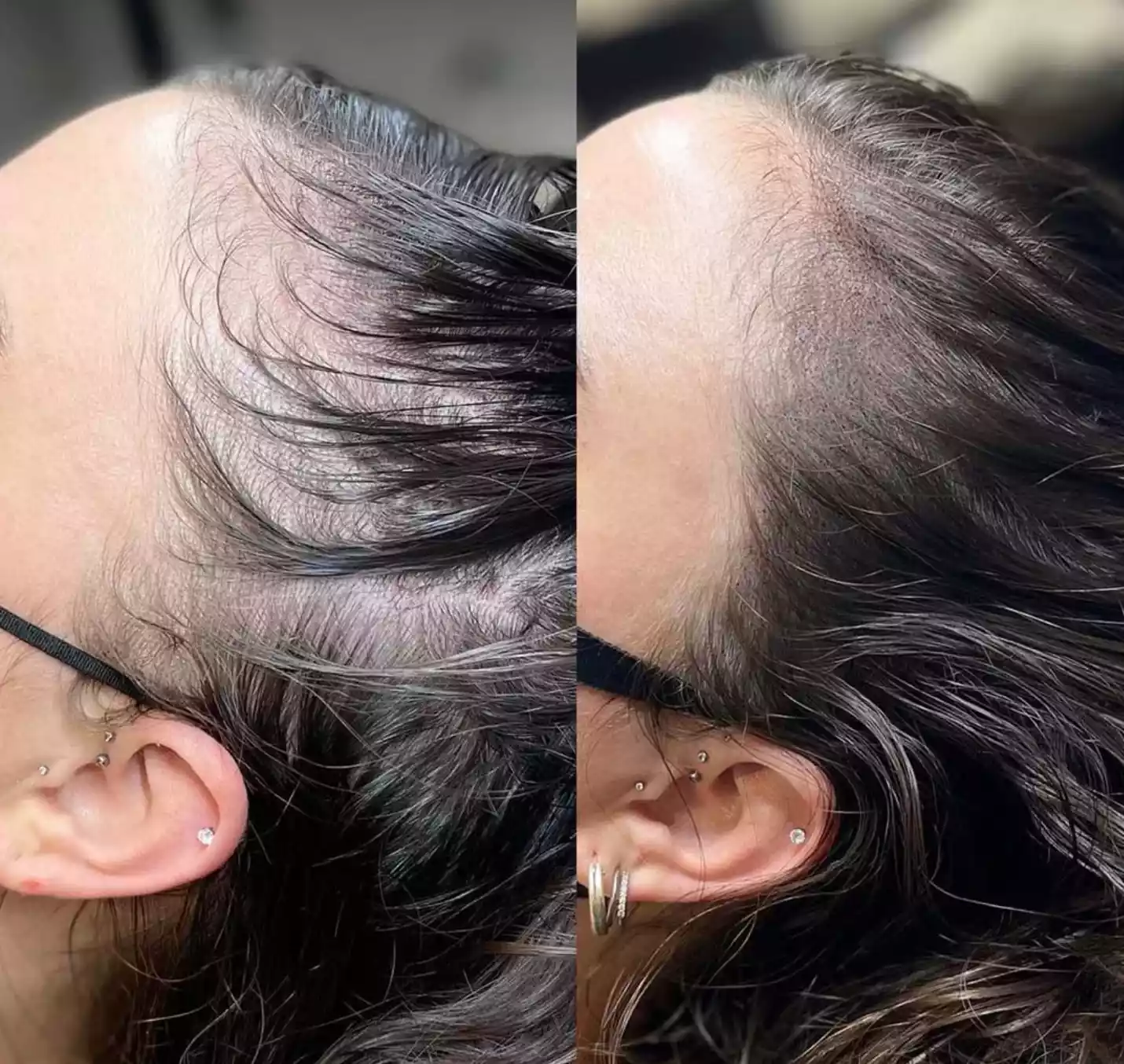 Male Pattern Baldness Solution