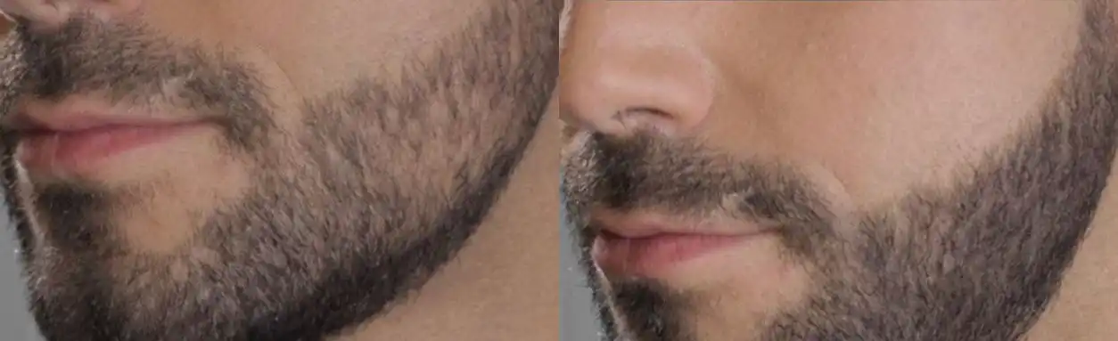 Beard micropigmentation