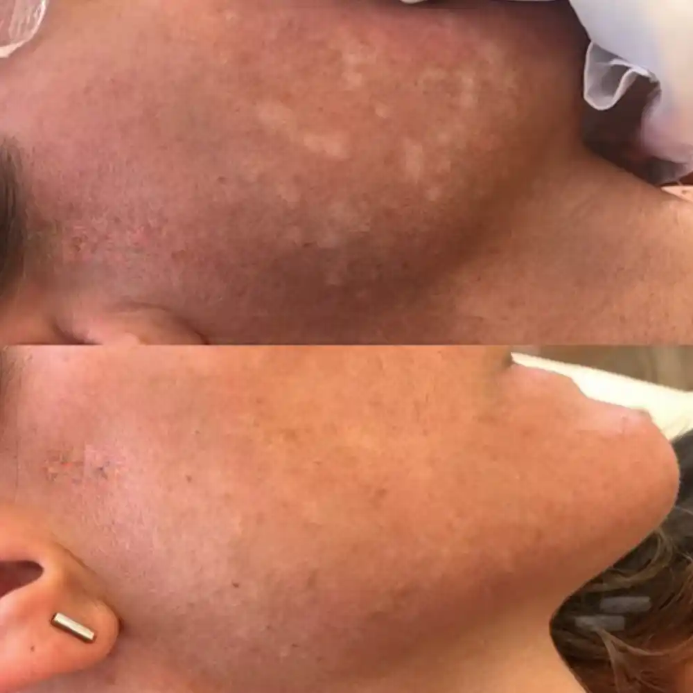 vitiligo treatmenet before after 1