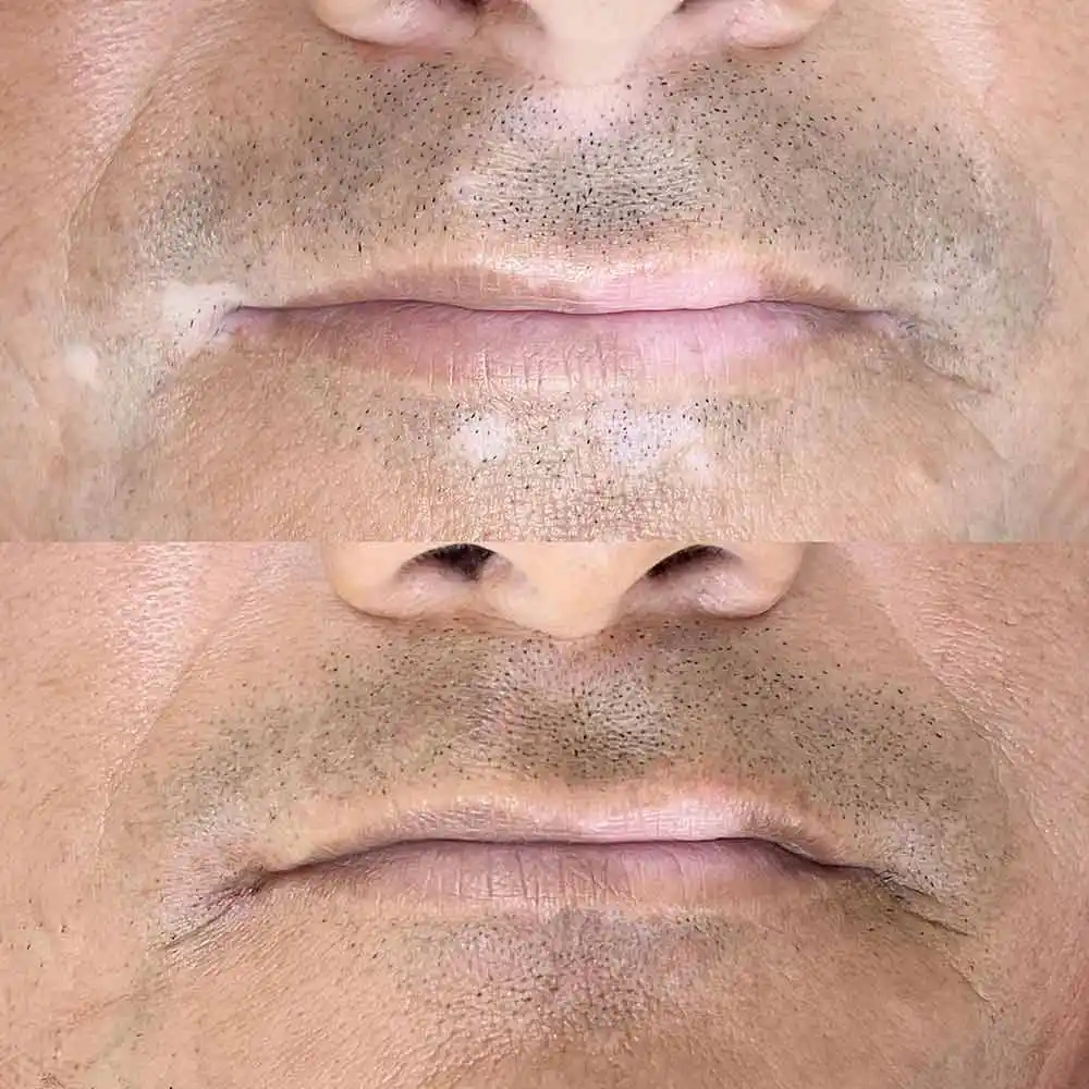 vitiligo treatmenet before after 3
