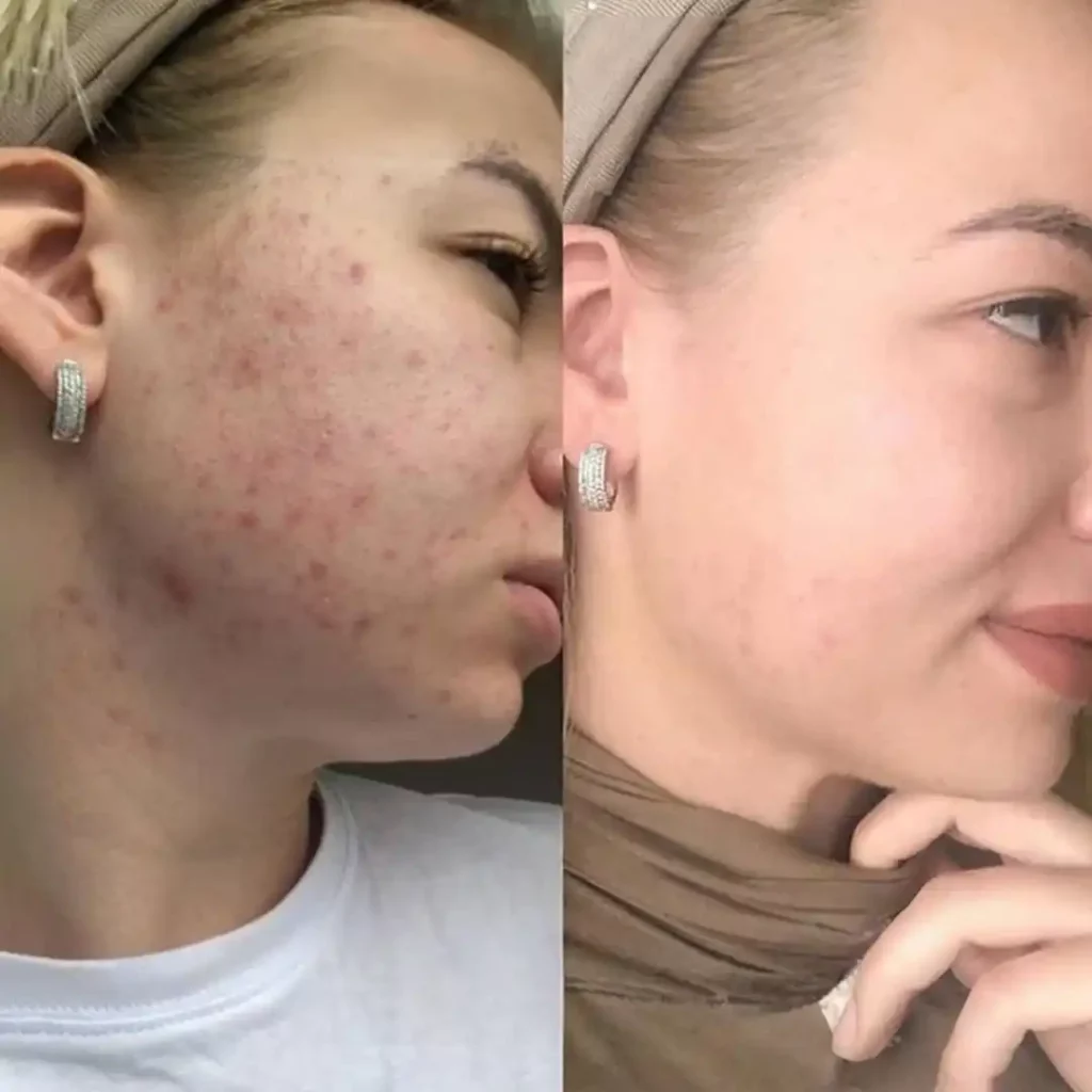 Skin Biorepeel before after 1