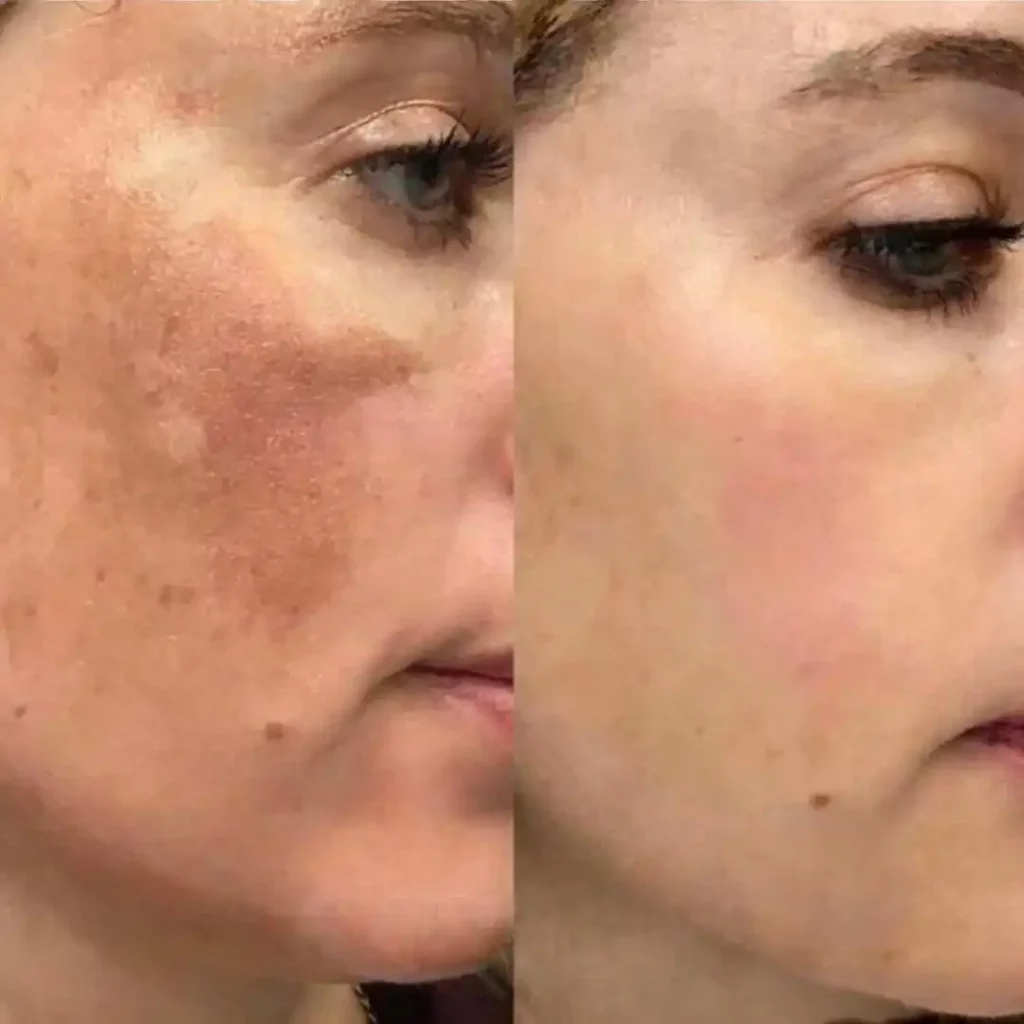 Skin Biorepeel before after 2