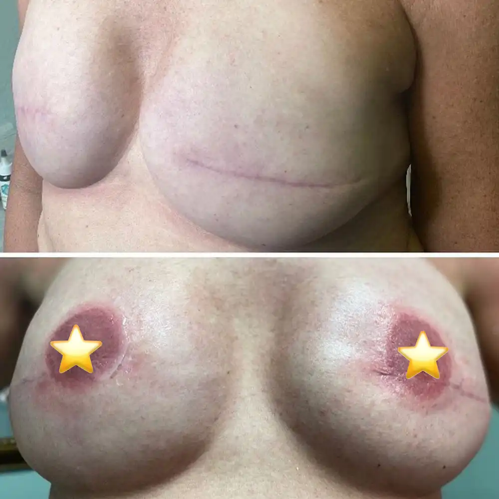 анатомия-сзади-после операции онемение груди