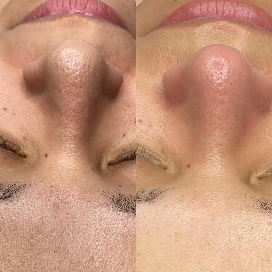 deep-cleansing-facial-before-after