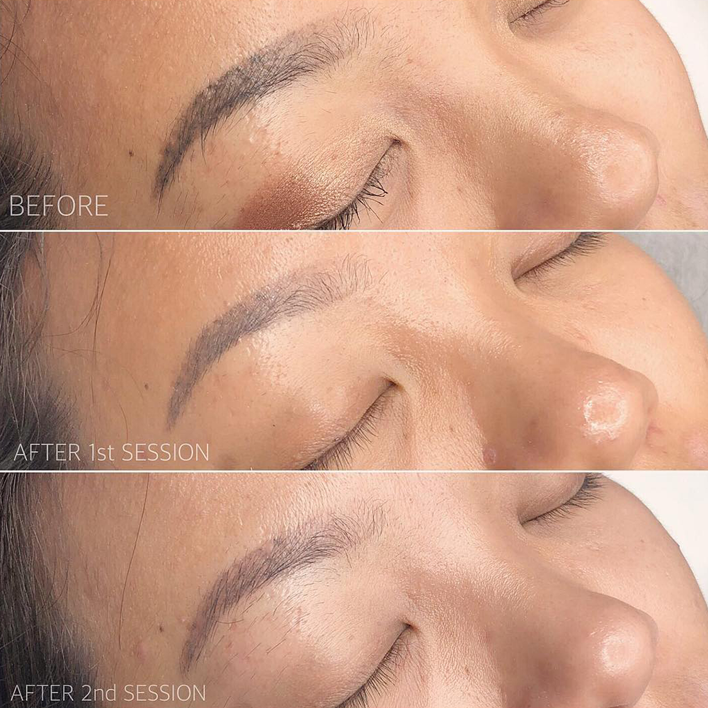 laser eyebrows tattoo removal