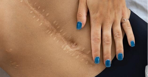 Paramedisinsk tatovering