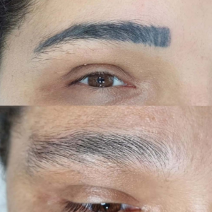 Permanent Makeup Removal