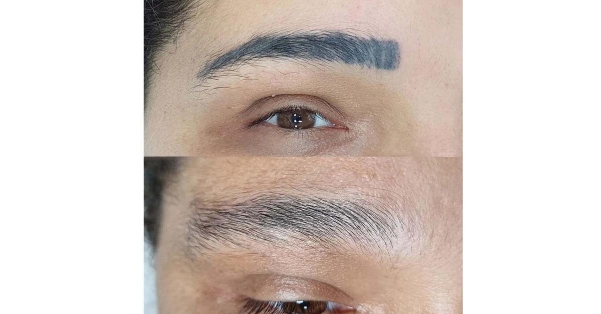 Permanent Makeup Removal